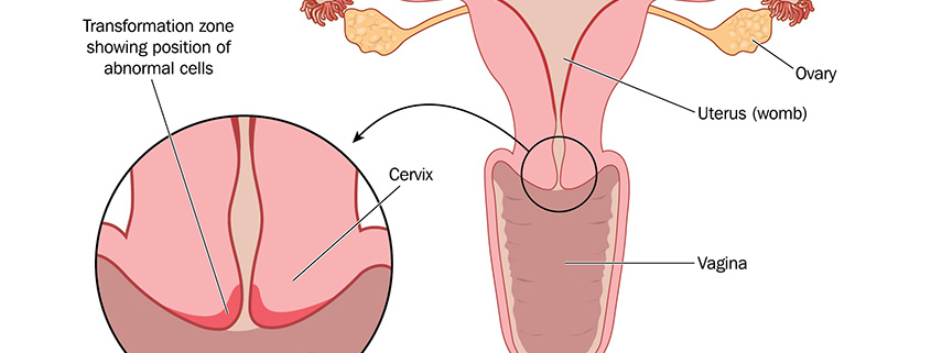 Cervical Cancer